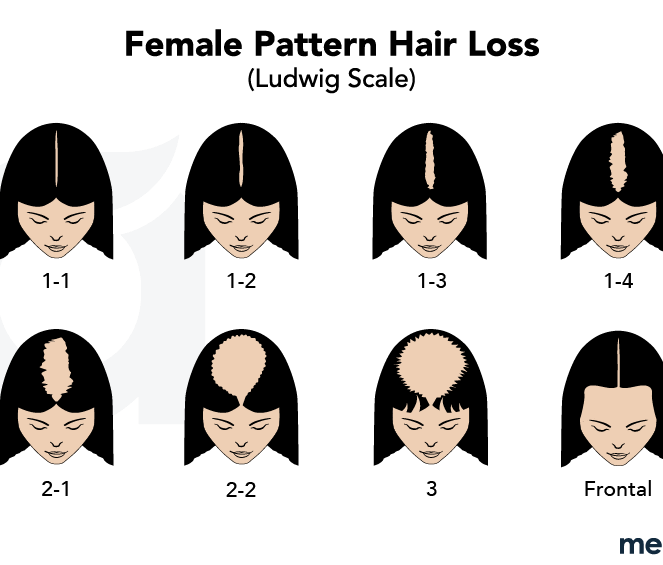 Illustrations showing different patterns of male hair loss from multiple angles.